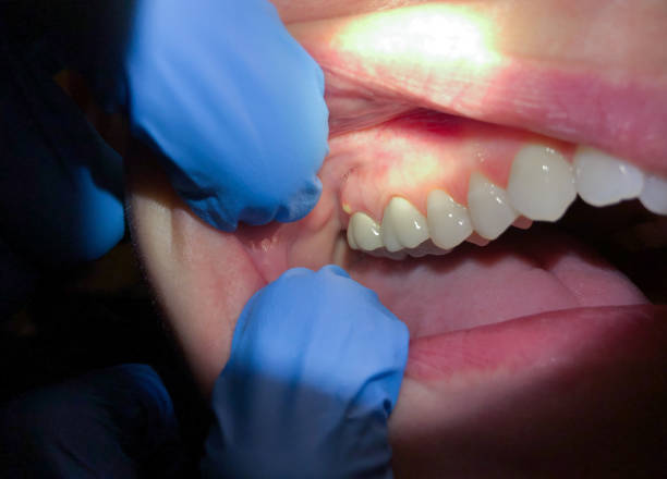 Best Emergency Wisdom Teeth Removal in St James City, FL