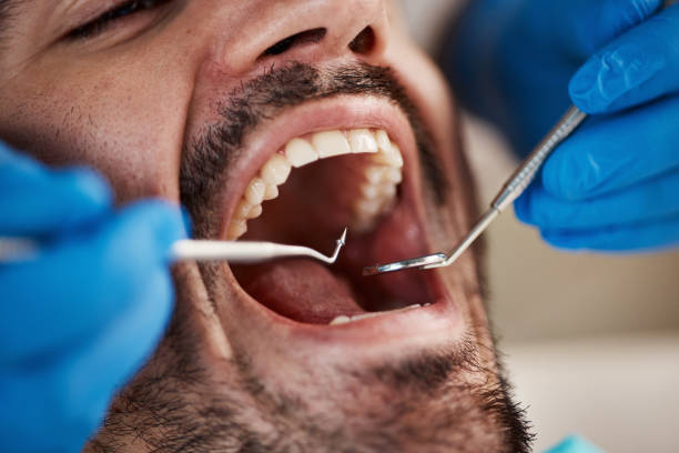Best Emergency Dental Care for Broken or Chipped Teeth in St James City, FL