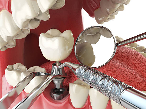 Best Emergency Root Canal Treatment in St James City, FL