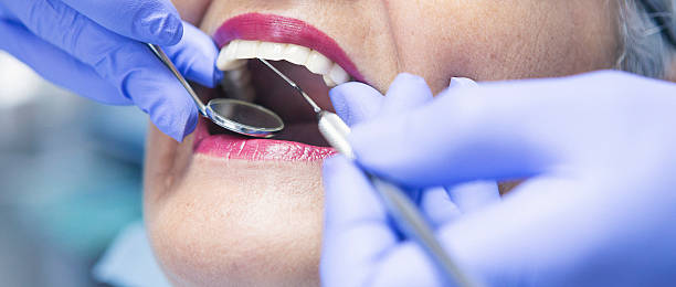 Best Emergency Tooth Extraction in St James City, FL